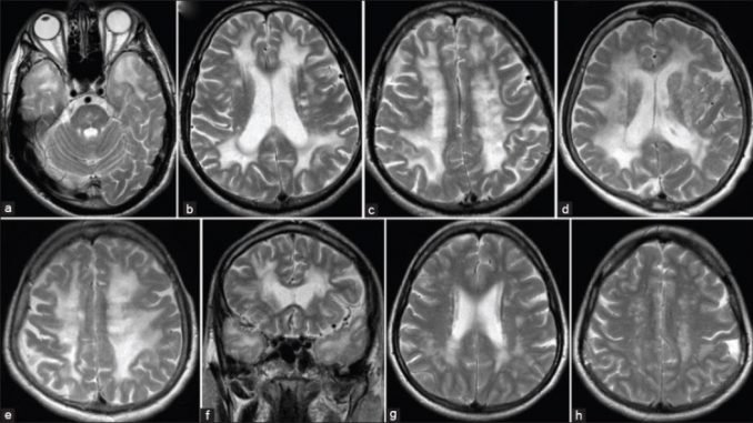 MRI of three different patiens from one family (mother, son, doughter). a) axial T2-weighted image shows characteristic changes in CADASIL - anterior temporal pole hyperintensities; b,d,g) axial T2-weighted images show periventricular hyperintensities; f) coronal T2-weighted image shows periventricular hyperintensities; c,e,h) axial T2-weighted images show hyperintensities in the deep white matter.