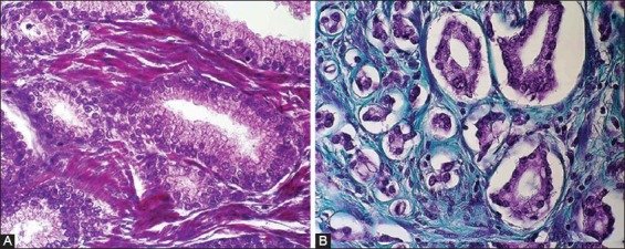 Mallory or Masson trichrome staining in A) benign prostate hyperplasia (x400) and B) prostate cancer