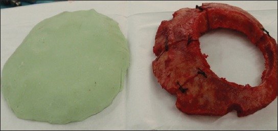 An example of biomaterial implementation for reconstruction of cranial bone defects. After cranial surgery, artificial flaps made of methylmetacrylate are being used for covering of bone defects. Such artificial flap (on the left) was made according to the original and will replace the damaged original bone flap (right).