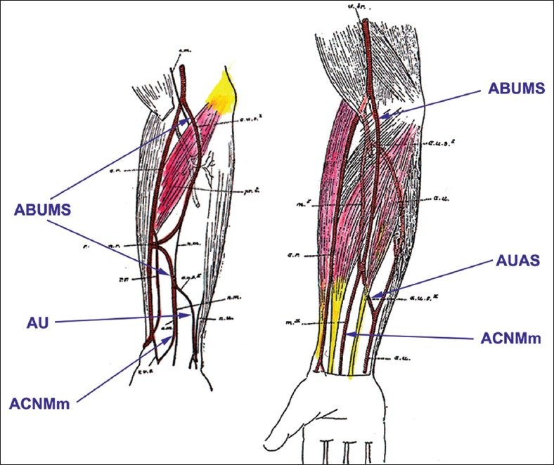 The scheme of two cases of a variant artery as drawn by Schwalbe in 1898. Legend: ABUMS – arteria brachioulnomediana superficialis, ACNMm – arteria comitans nervi mediani manus, AUAS – arteria ulnaris accessoria superficialis, AU – arteria ulnaris.