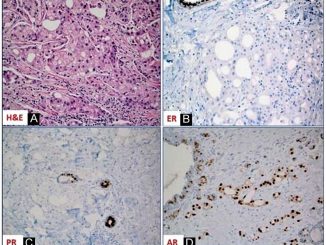 Apocrine carcinoma of the breast: A brief update on the molecular features and targetable biomarkers
