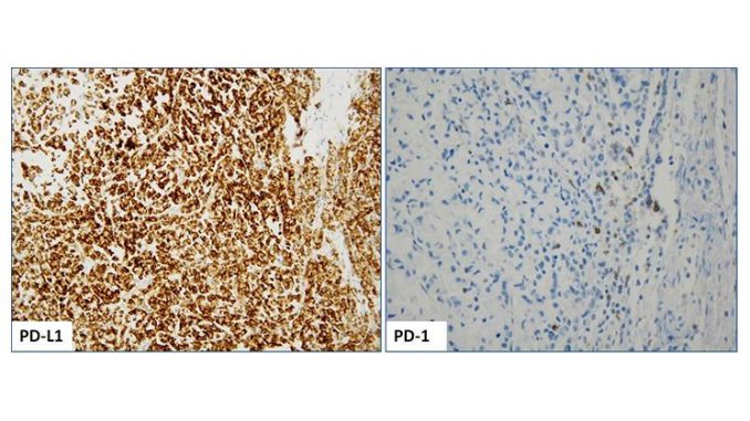 Positive PD-L1 (SP142 clone) IHC staining (2+, 85%) of a MSI-H colorectal tumor with concurrent BRAF V600E mutation; image taken at 20x magnification (Left image); Positive PD-1 (Cell Marque) IHC staining; image taken at 40x magnification (Right image).