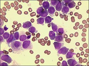 Acute promyelocytic leukemia with a novel complex karyotype
