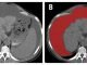 CT in the diagnosis of intraperitoneal effusions