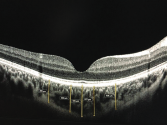 How are central foveal and choroidal thickness affected in patients with mild COVID-19 infection?