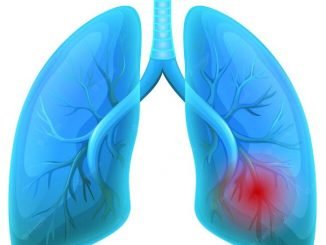 Researchers may have uncovered a new non-small cell lung cancer biomarker