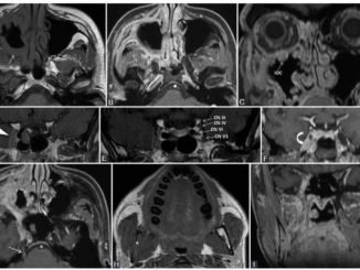 The Hidden Challenge: Imaging Perineural Invasion in Head and Neck Tumors