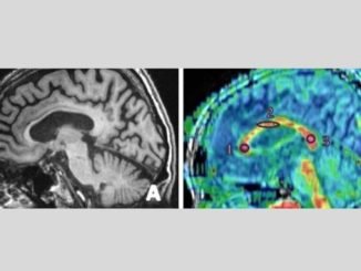 Revolutionizing Dementia Diagnosis: The Power of MRI