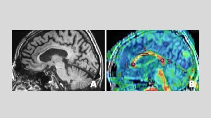 Revolutionizing Dementia Diagnosis: The Power of MRI