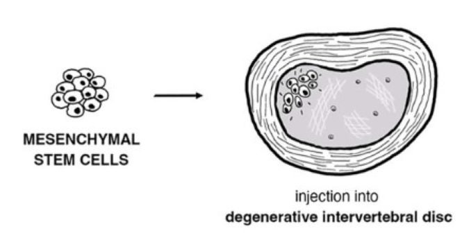 Regenerative Medicine: Stem Cell Therapy’s Potential in Treating Degenerative Disc Disease